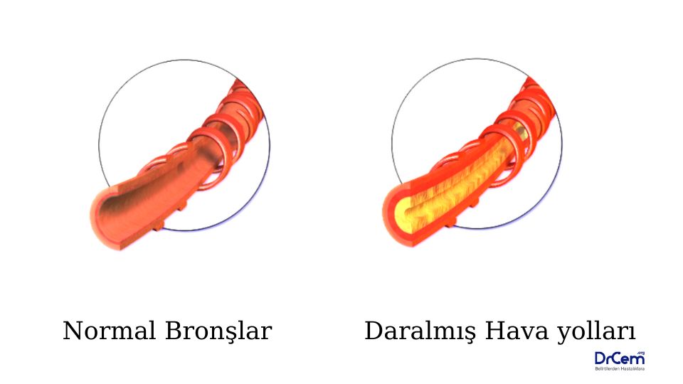 Akut Bronkospazm görseli - DrCem hastalık rehberi